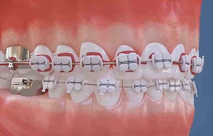 Sống khỏe 360 -  Hậu quả của việc niềng răng không đúng quy trình (04-12-2020)